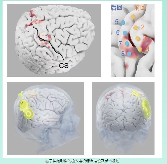 Neuralink革命性进展：马斯克确认2025年将为20至30名患者提供脑机接口植入_Neuralink革命性进展：马斯克确认2025年将为20至30名患者提供脑机接口植入_Neuralink革命性进展：马斯克确认2025年将为20至30名患者提供脑机接口植入