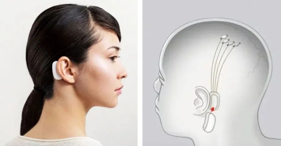 马斯克发明植入脑机接口_脑机接口的未来：马斯克确认2025年Neuralink将为20至30名患者实施植入_马斯克脑机接口治疗中风后遗症